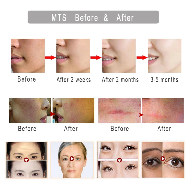 Derma Roller  Needle Skin Care Treatment Scalp